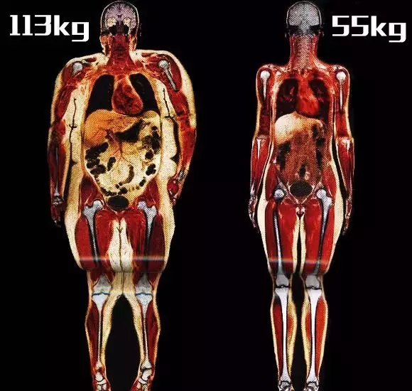 相同身高下,肥胖者与正常者皮下脂肪对比
