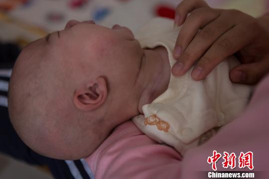 孩子出生后第15天，于丽静发现小坚果颈部右边比左边粗，而且长出了花生米大小的包块。孩子满月时已长到鸡蛋黄那么大。图为术后小坚果的脖颈处留下的伤疤。范丽芳 摄